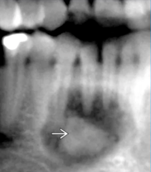 <p>corticated border with WIDE zone of transition, lucent rim</p>