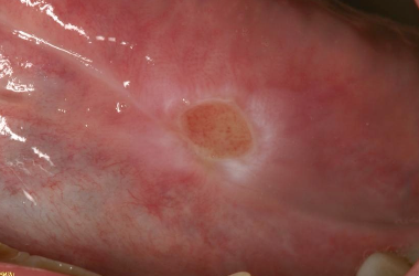 <p>Where are the most common injuries for a traumatic/nonspecific ulcer? </p>