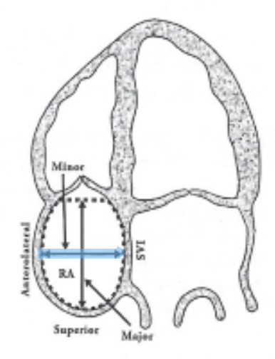 <p>Go perpendicular to long-axis, mid-level of right atria free wall to IAS</p>