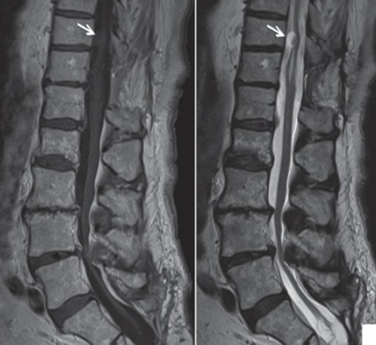 <p>neurenteric cyst</p>