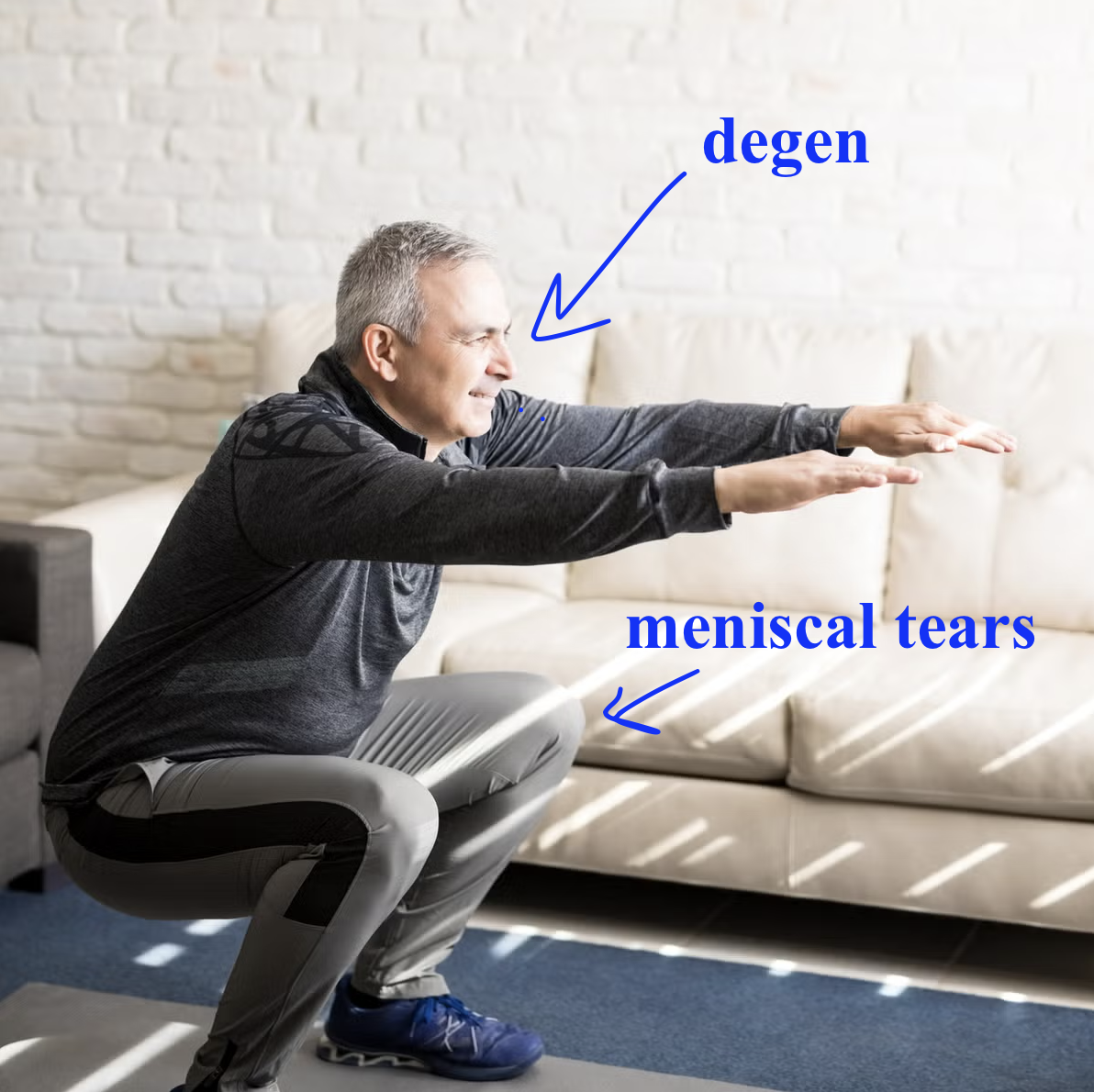 <ul><li><p>Age over 60</p></li><li><p>male gender</p></li><li><p>repetitive kneeling</p></li><li><p>squatting</p></li><li><p>stair climbing</p></li><li><p>60 y.o. M bending his knees → <span>meniscal tears</span></p></li></ul><p></p>