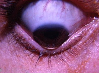 <ul><li><p><span><strong>Bulging of the lower lid </strong>on <strong><u>downgaze </u></strong>created by the <u>conical appearance</u> of the cornea</span></p></li><li><p><span>Creating a V shape of the lower eyelid</span></p></li></ul><p></p>