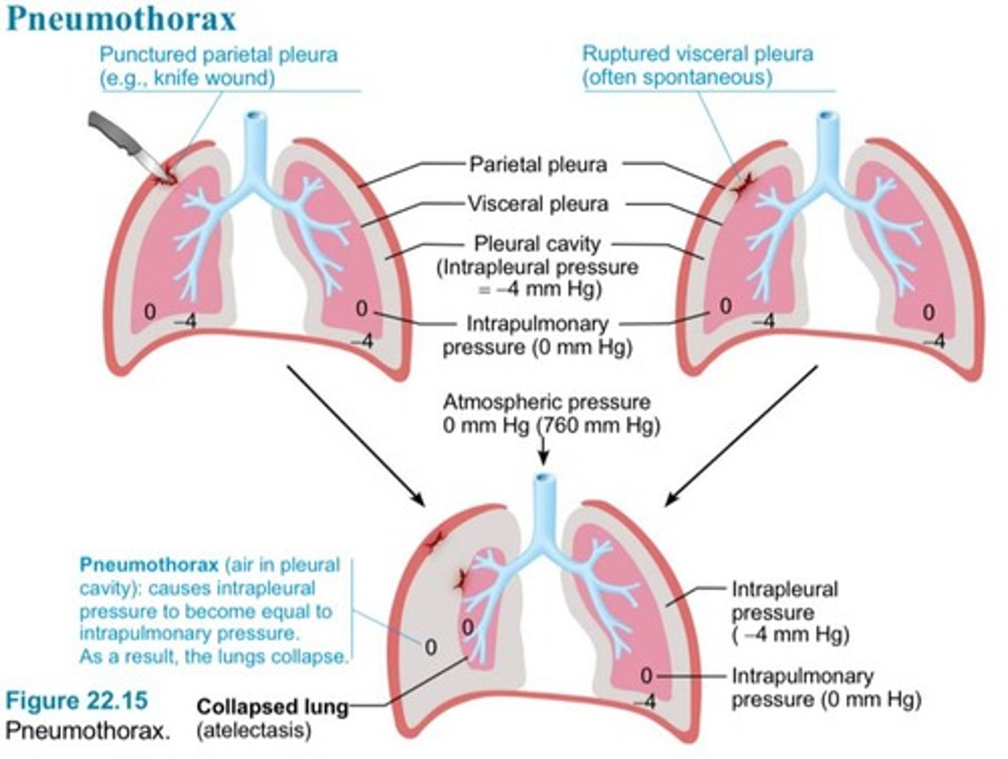 <p>The last tracheal cartilage that is expanded and sensitive; triggers coughing if irritated.</p>