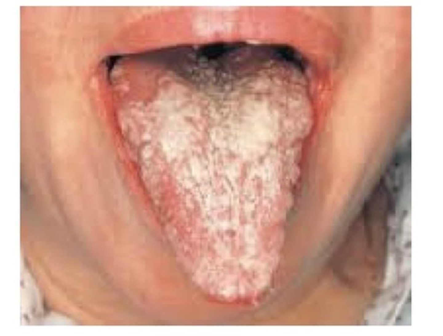 <p>Clinical appearance of the oral mucosa: dry, smooth, thin. This can be caused from broad-spectrum antibiotics. Resulting from Xerostomia causing medications.</p>