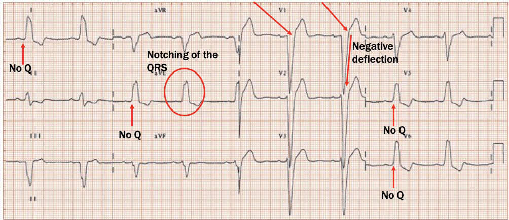 <p>V1: dominant S wave (W)</p><p>Lead I: wide QRS, RS pattern</p><p>Lateral leads: no Q waves, notched QRS (double QRS) =broad notched R (M)</p>