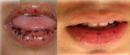 <p><strong><u>Oral melanotic macule</u></strong></p><p class="has-focus">Most common oral pigmentation of fair complexioned children</p><p class="has-focus">Multiple lip macules in Peutz-jeghers syndrome</p><p class="has-focus"></p><p class="has-focus is-empty"><strong>Treatment </strong>- None unless menalocytic neoplasm cannot be excluded. Otherwise (if not neoplasm), no potential for malignant transformation.</p><p class="has-focus"></p><p class="has-focus is-empty"><em>DD - Amalgam/graphite tatoo, Melanocytic nevus, Smokers melanosis, Late eccymyosis</em></p>