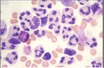 <p>A cloudy CSF sample has a white count of over 1000 WBC/uL. Large number of these cells seen in cytocentrifuged smear is suggestive of:</p><p>Viral meningitis</p><p>Bacterial meningitis</p><p>Fungal infection</p><p>Malarial infection</p>