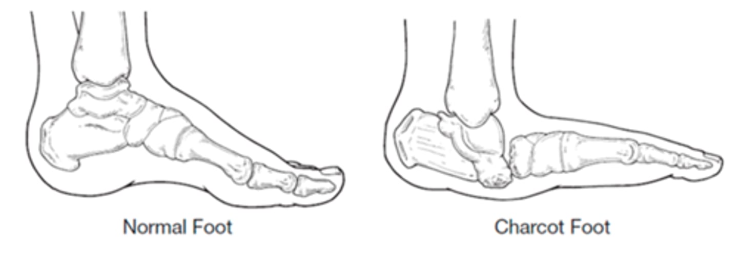 <p>Deformity of the foot secondary to the motor changes of diabetic neuropathy that leaves the patient susceptible to callus &amp; ulcer formation</p>