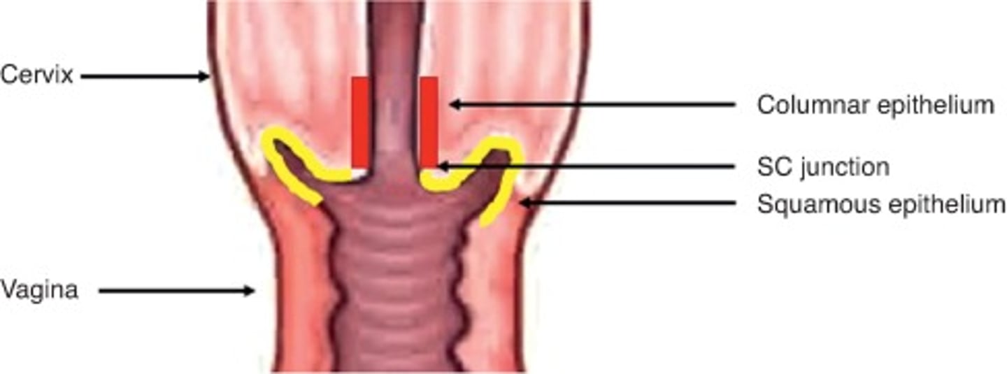 <p>Hysterectomy approaches:</p><p>- cut inside vagina, at top junction of vaginal wall near cervix; suture site at vaginal cuff (no external incision)</p><p>- preferred ↓ complications + LOS + healing time</p><p>- indications: uterus prolapse, early stage cervical/uterine ca, vaginal repair w/ removal of uterus, too large for laproscopy</p>