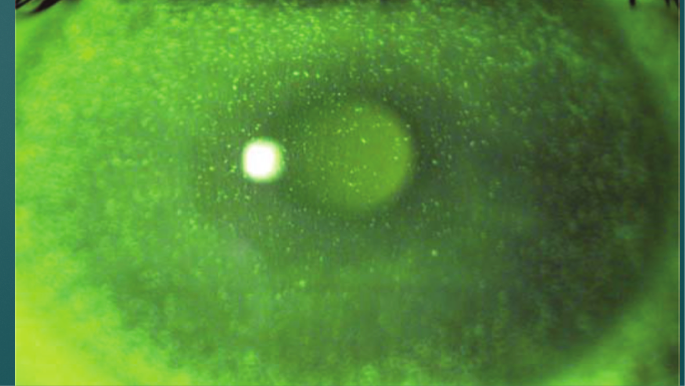 <p>UV light is the most common cause of radiation injury to eye</p><p>Cornea epithelium absorbs UV radiation- cumulative</p><p>Prolonged exposure can lead to chronic toxicity, which is associated with pinguecula, pterygium, squamous metaplasia and carcinoma</p><p>Inflammation- edema, superficial puctate keratits (SPK, pictured) to total desquamation</p><p>Reepithelialization- can occur in 36-72 hrs</p><p>Sunburn to cornea</p>