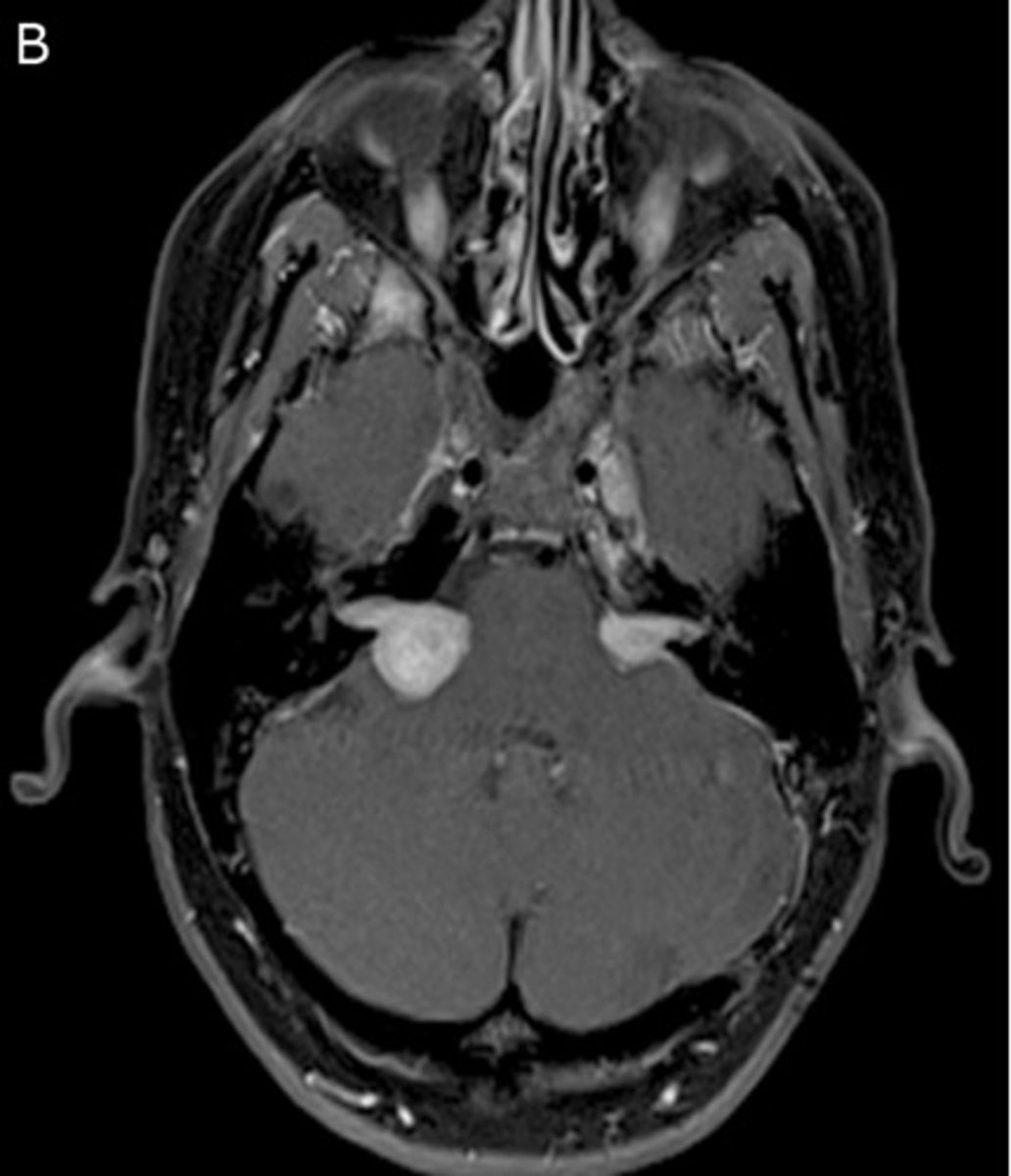 <p>Develops after age 15 --&gt; Causes tumor of the cochlear nerve</p>