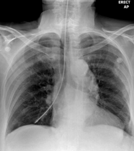<p>describe the incorrect NG tube placement</p>
