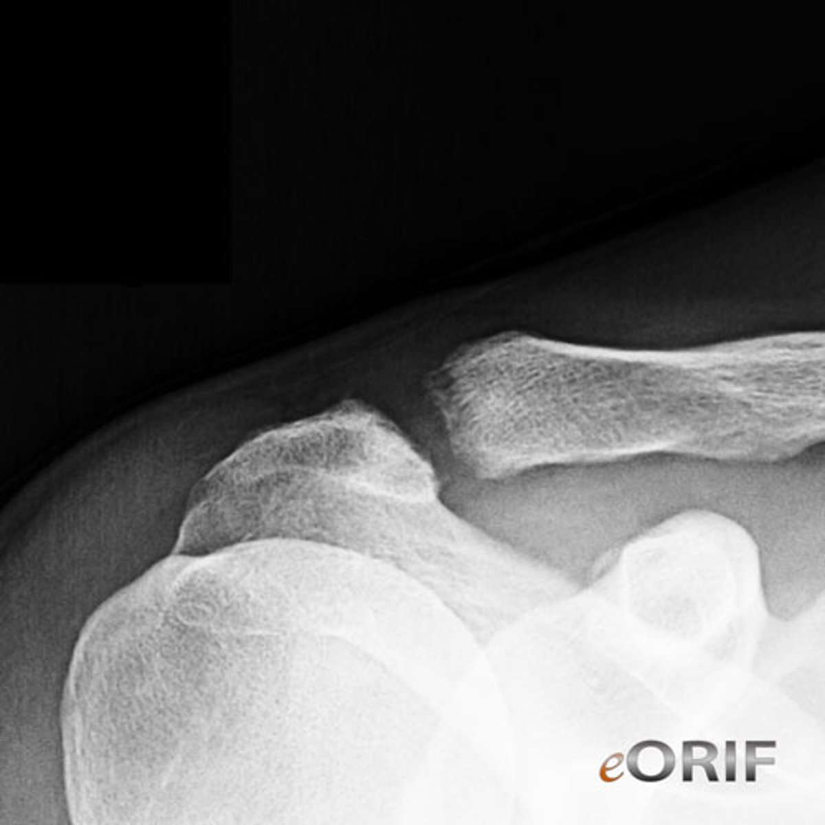 <p>frayed clavicle</p>