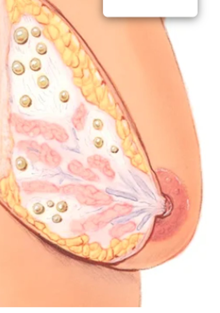 <p>Multiple tender masses that occur with numerous symptoms and physical findings: (1) swelling and tenderness (cyclic discomfort), (2) nodularity (significant lumpiness, both cyclic and noncyclic), (3) dominant lumps (including cysts and fibroadenomas), (4) nipple discharge (including intraductal papilloma and duct ectasia), and (5) infections and inflammations.</p>