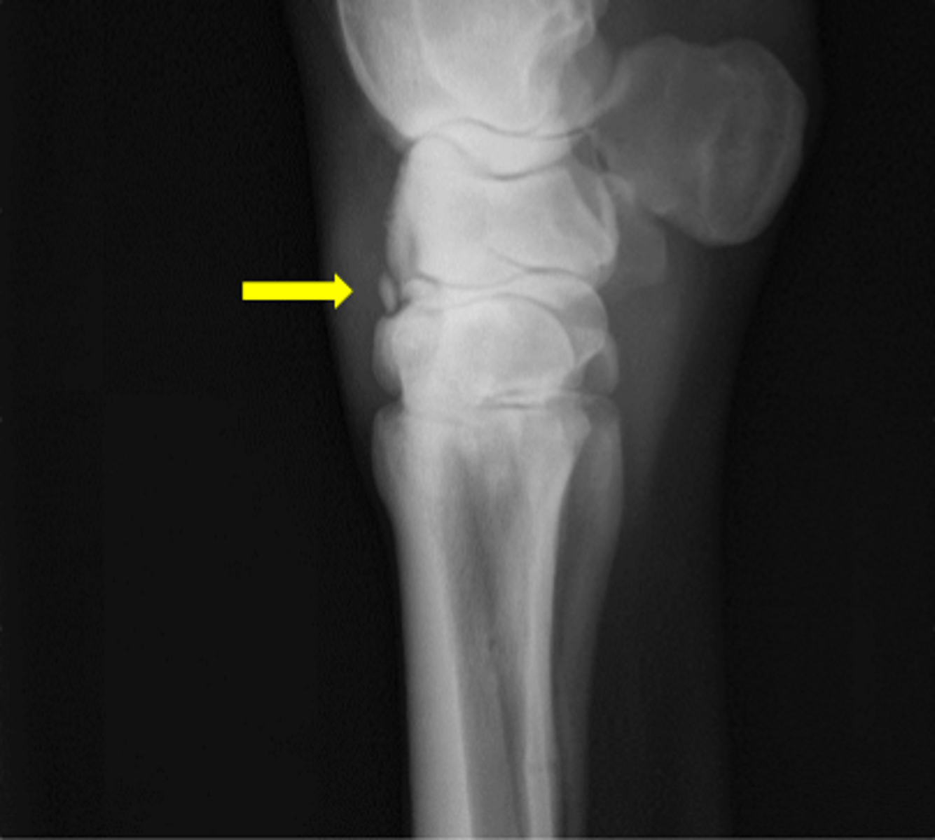 <p>What is the preferred treatment for this lesion?</p>