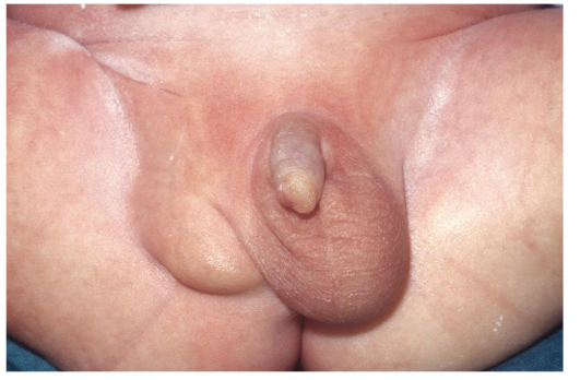 <p><span style="background-color: transparent;"><span>is a condition in which fluid has accumulated and causes swelling in the </span><u><span>scrotum.</span></u></span></p>