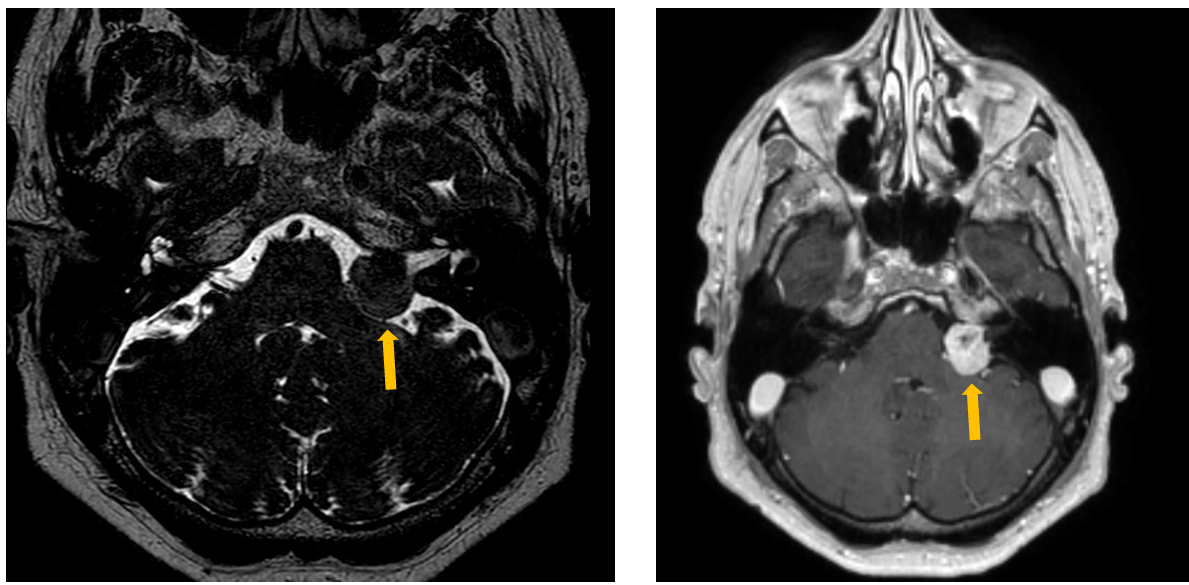 <p>Patient history: neural hearing loss, that developed over months</p><p>Modality: left – T2 Drive MRI (non-contrast), right – post-contrast T1W MRI (after iv. gadolinium administration) </p><p>Region: brain, axial view </p><p>Radiologic sign: well-circumscribed, contrast-enhancing mass in the left cerebellopontine angle (yellow arrows) </p><p>Diagnosis: vestibular schwannoma (acoustic neuroma)</p>