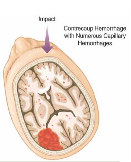 <p>Closed head injury</p><ul><li><p>damaged brain without open wound/penetration of foreign substance into brain </p></li><li><p>skull may be fractured but meninges intact</p></li><li><p>produces more complex symptoms than penetrating - widespread damage </p></li></ul><p></p>
