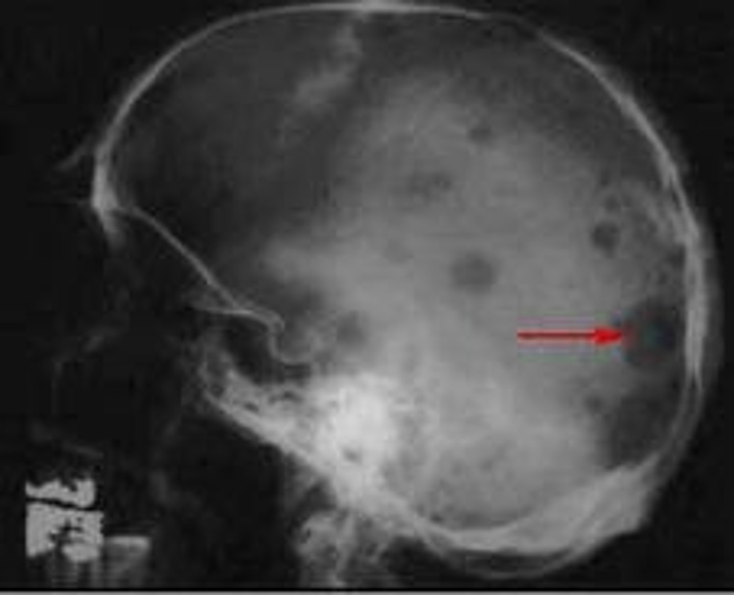 <p>Osteolytic neoplasm</p>