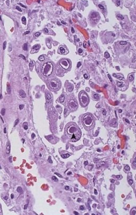 <p>8.1 Side A (PBD9: 359; BP9: 310)<br></p>
<p><br></p>
<p>Questions<br></p>
<p>After a recent allogeneic bone marrow transplant, a 30-year-old woman develops fever, cough, and dyspnea; she is pancytopenic with markedly reduced numbers of granulocytes and lymphocytes. A bronchoscopic biopsy specimen has the microscopic appearance shown.<br></p>
<p><br></p>
<p>1. What is your diagnosis?<br></p>
<p>2. When did this infection start?<br></p>
<p>3. How does the causal agent avoid detection and destruction by the cell-mediated immune system?<br></p>