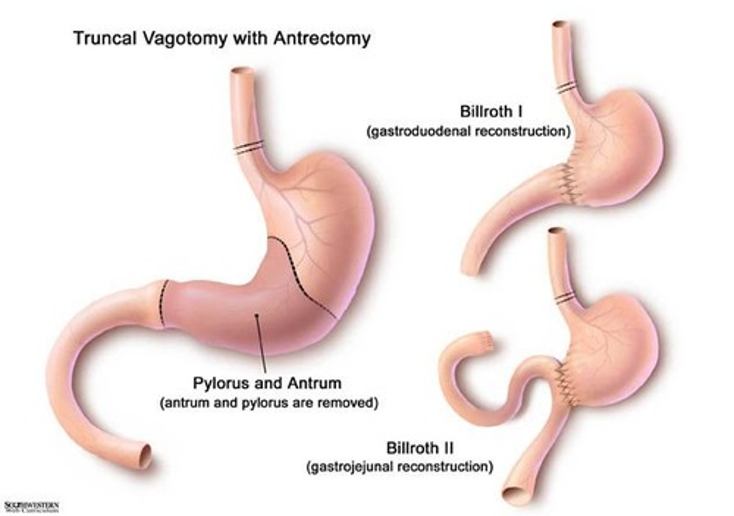<p>Gastroduoden-ostomy</p><p>Attaches remaining stomach to the duodenum</p>