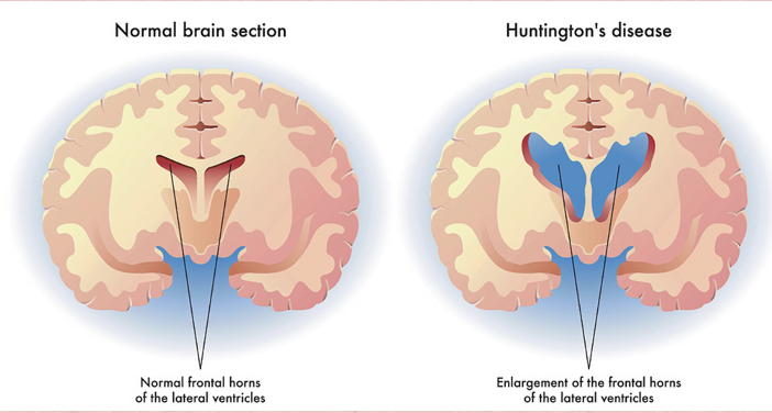 <ul><li><p><span style="color: yellow"><strong>Premature death of cells in</strong></span>:</p><ul><li><p>Striatum of <span style="color: yellow"><strong>basal ganglia</strong></span> (involved in movement control) + <span style="color: yellow"><strong>Cortex</strong></span> (involved with thinking, memory, perception, judgment &amp; behavior) + <span style="color: yellow"><strong>Cerebellum</strong></span> (voluntary muscle activity coordination)</p></li></ul></li><li><p style="text-align: left">Cause not known but possibly due to glutamine collecting in cell nucleus abnormally → cell death</p></li><li><p style="text-align: left"><span style="color: yellow"><strong>Hereditary; passed on by autosomal dominant gene</strong></span>:</p><ul><li><p>Each child of parent with disease have 50% chance of inheriting</p></li><li><p><strong>Genetic testing</strong>:</p><ul><li><p>Identify gene presence but not timing of onset</p></li></ul></li></ul></li><li><p><strong>Everyone has the gene for Huntington Disease BUT the people with the expansion of the gene can develop the disease and pass it on</strong></p><ul><li><p>Affects 1 in 10,000 men and women at midlife—rare</p></li><li><p>Choreiform movements even when asleep</p></li></ul></li></ul><p></p>