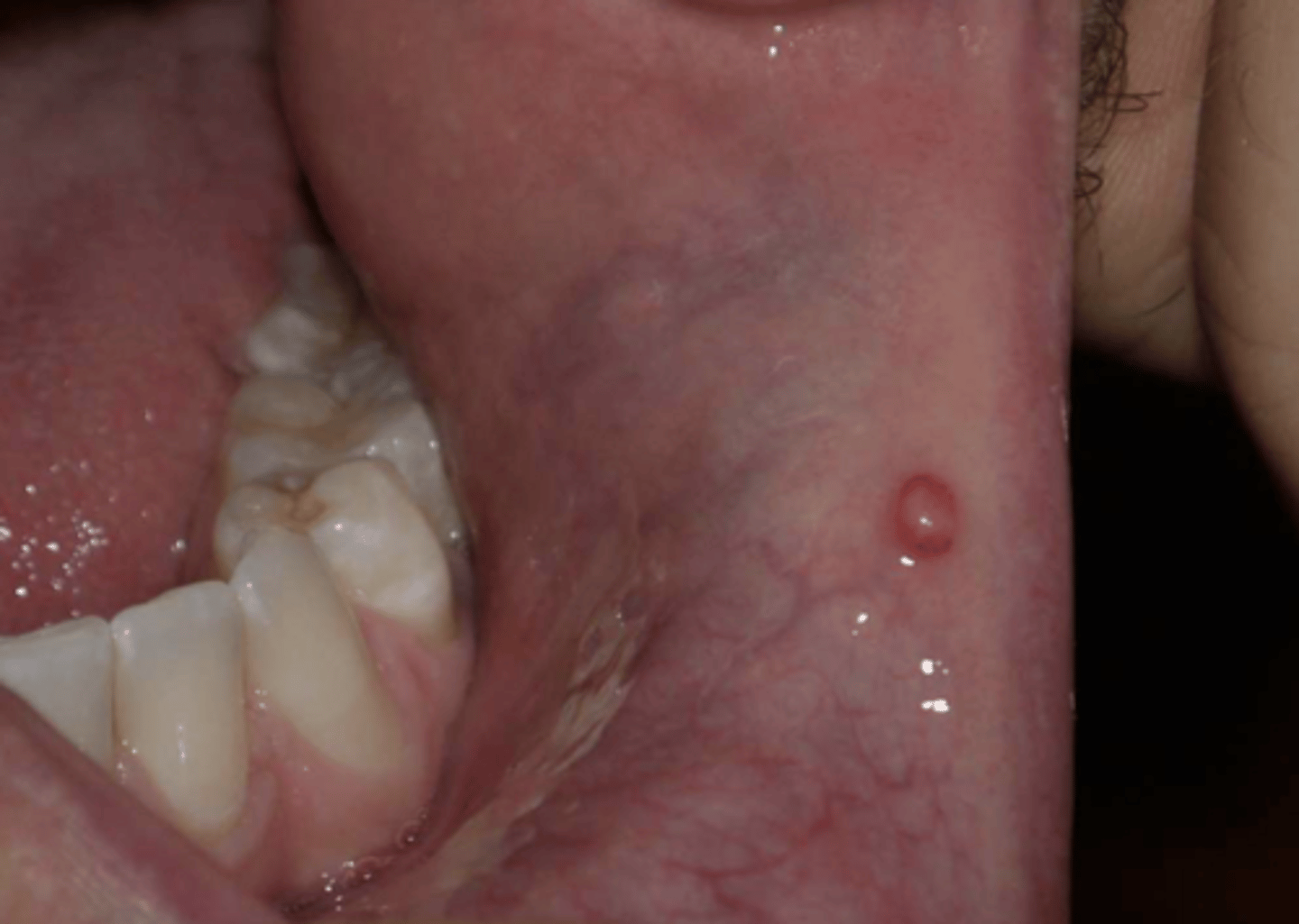 <p>ID the pathology based on the histology findings:</p><p>– Spilled mucin surrounded by granulation tissue</p><p>– Numerous neutrophils and foamy histiocytes/muciphages</p><p>- No epithelial lining</p>