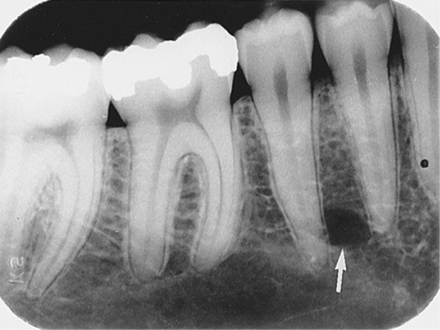 <p>Radiolucent round/oval area near mandibular premolars</p>