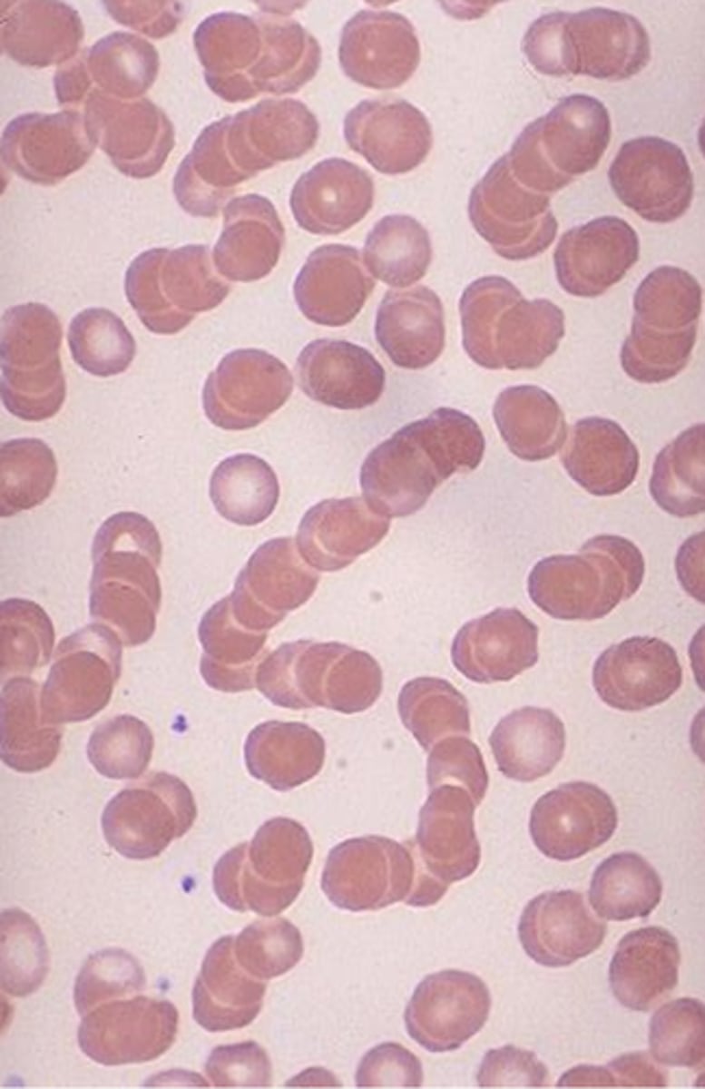 <p>RBCs stack up on each other; excessive protein in the blood</p>
