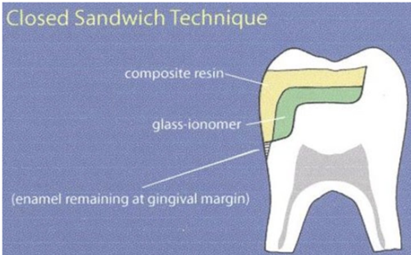 <p>What 2 materials do you use in sandwhich combo?</p><p>a. Calcium Hydroxide and Composite</p><p>b. Calcium Hydroxide and Glass Ionomer</p><p>c. Calcium Hydroxide and Zinc Oxide Eugenol</p><p>d. Composite and Glass Ionomer</p><p>e. Composite and Zinc Oxide Eugenol</p><p>f. Glass Ionomer and Zinc Oxide Eugenol</p>