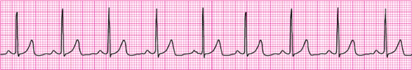 <p>Normal Sinus Rhythm</p>