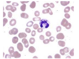 <p><span style="font-family: Helvetica; font-size: 12px;">Which of the following diseases is most closely associated with cytoplasmic granule fusion as seen in this picture:</span></p>