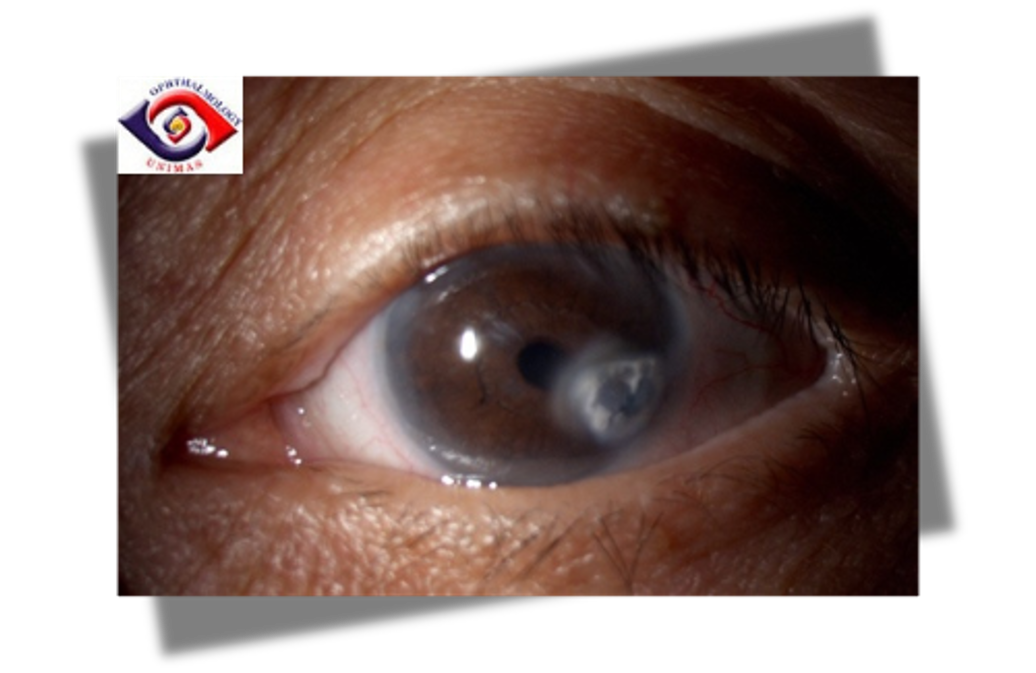 <p>acute painful red eye with corneal abnormality; hazy cornea</p>