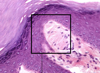<p>Type of encapsulated nerve ending found in the dermis, responsible for detecting light touch and vibration. Oval, light staining, wavy structures in dermal papillae.</p>