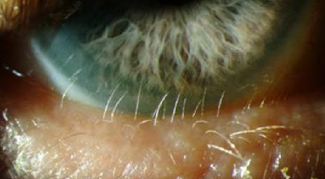 <p>What eyelash condition is this?</p>