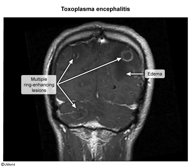 <p>toxoplasma, can reactivate if cd4 <100</p><p>could be tx/prevented with tmp-smx</p>