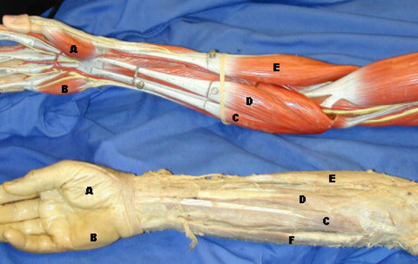 <p>C-, Description: Between flexor carpi radialis and flexor carpi ulnaris, humerus to skin and fascia of palm</p>