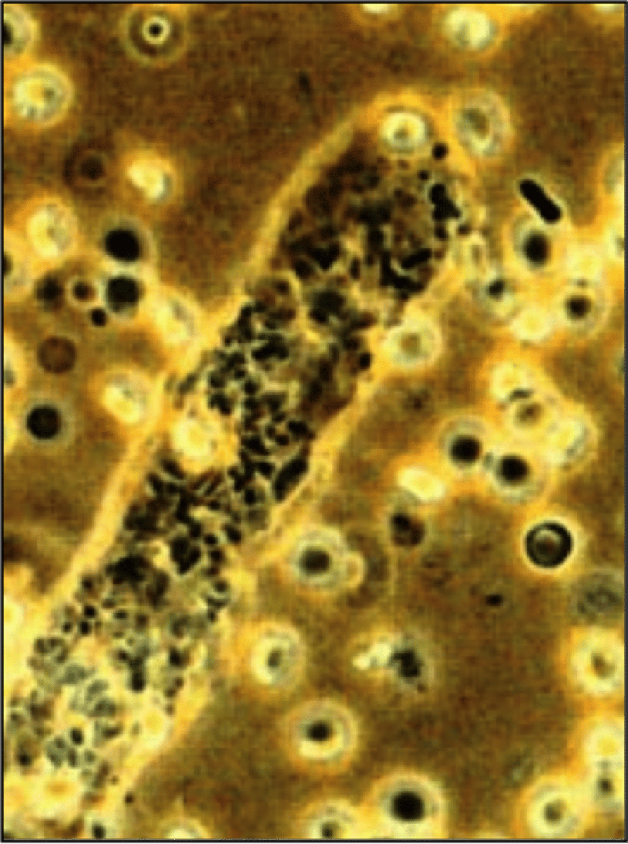 <p>They contain both bacilli within and bound to the outside of the cast. This is sen in pyelonephritis.</p><p>There presence should be considered when WBC casts and may free WBCs and bacteria are seen in the sediment.</p>