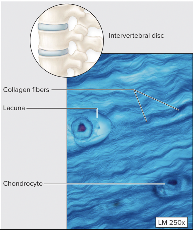 * Parallel collagen fibers in matrix; chondrocytes in lacunae
* Loaded with collagen fibers
* No **perichondrium**
* Absorbs shock; resists compression
* Example: intervertebral discs