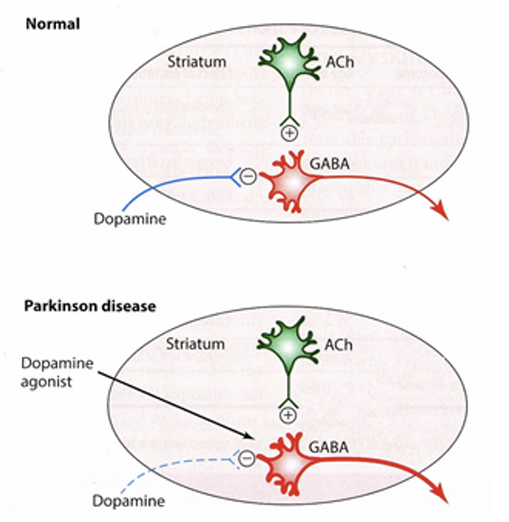 <p>Biperideen is een muscarine-antagonist. Door de depletie van dopamineerge neuronen is er minder dopamine. Normaliter is er een balans tussen de stimulatie van GABAerge neuronen door dopamine en de remming van GABAerge neuronen door acetylcholine. Nu er echter minder dopamine is, is er relatief veel acetylcholine en dus relatief ook meer remming van de GABAerge neuronen. Dit geeft bepaald symptomen. Door een muscarine-antagonist te geven, zal er minder effect van acetylcholine zijn en zullen er minder symptomen ervaren worden. </p>