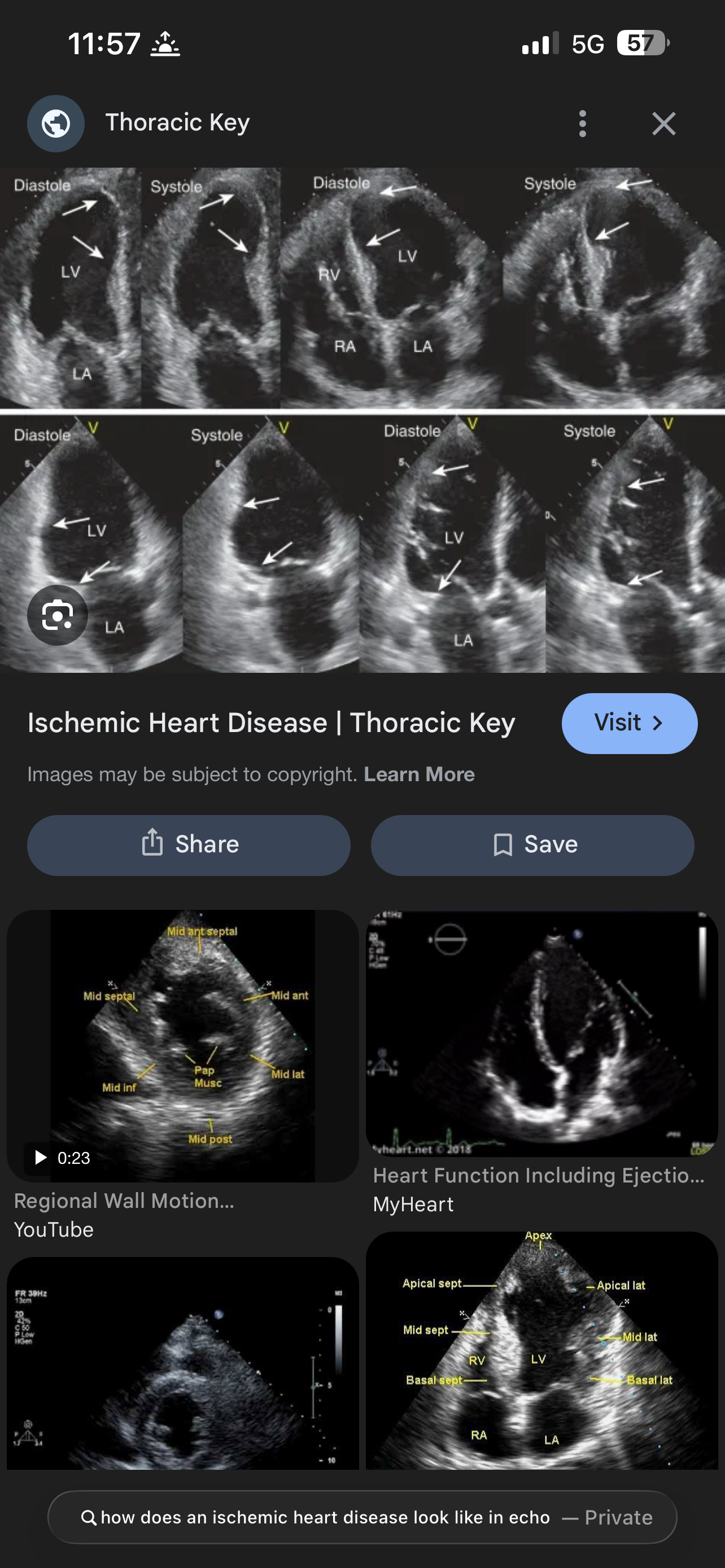 <p>Whats Ischemic Heart Disease ?</p>