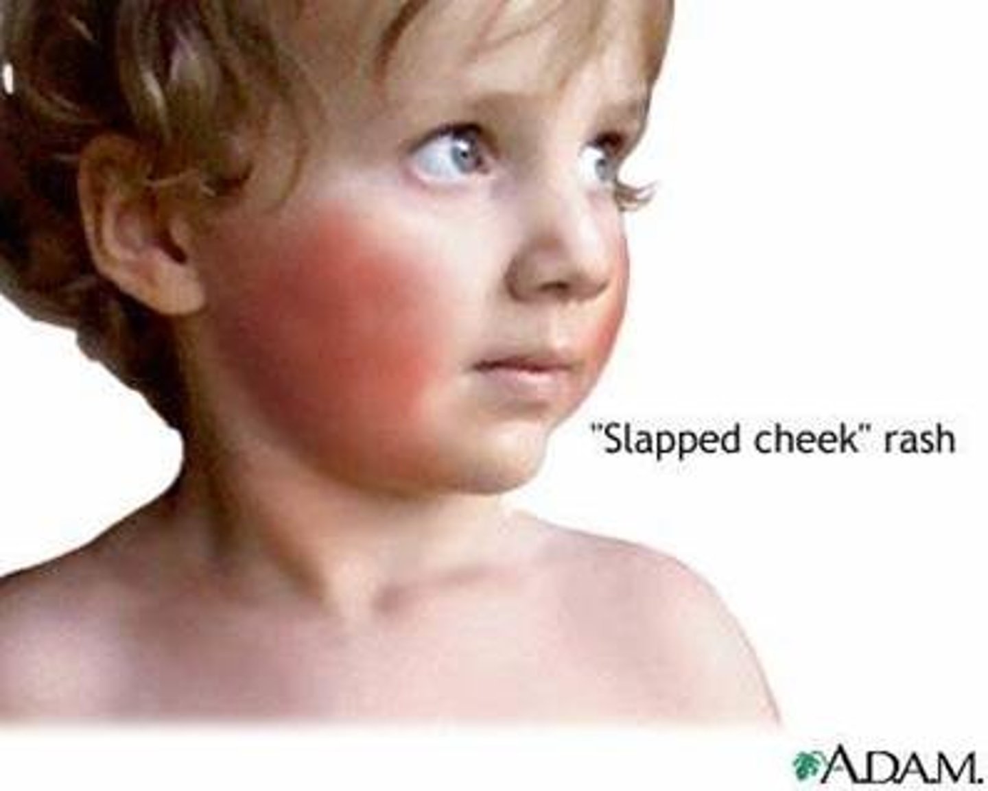 <p>"Slapped cheeks" rash</p>