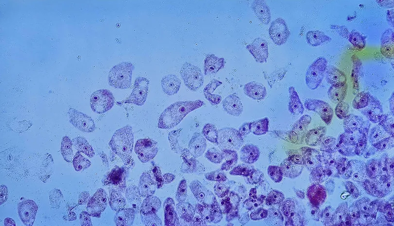 <p><strong><span>🔬🧫 </span>Na podstawie zdjęcia preparatu:</strong></p><p></p><ul><li><p><span>📖 </span>rozpoznaj gatunek pasożyta;</p></li></ul><p></p><ul><li><p><span>♻ </span>rozpoznaj wszystkie formy rozwojowe;</p></li></ul><p></p><ul><li><p><span>🦠 </span>wskaż organelle i cechy charakterystyczne dla danego gatunku (jeśli to możliwe);</p></li></ul><p></p><ul><li><p><span>😷 </span>nazwij chorobę, którą pasożyt wywołuje.</p></li></ul><p></p>