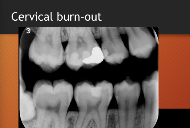 <p>root caries</p>