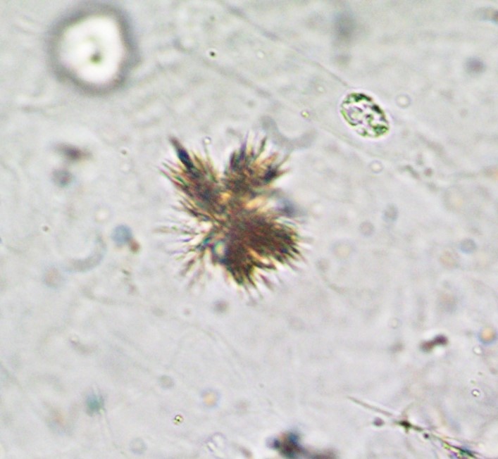 <p>Colorless to yellow needles in rosettes<br>Significance: Liver disease</p>