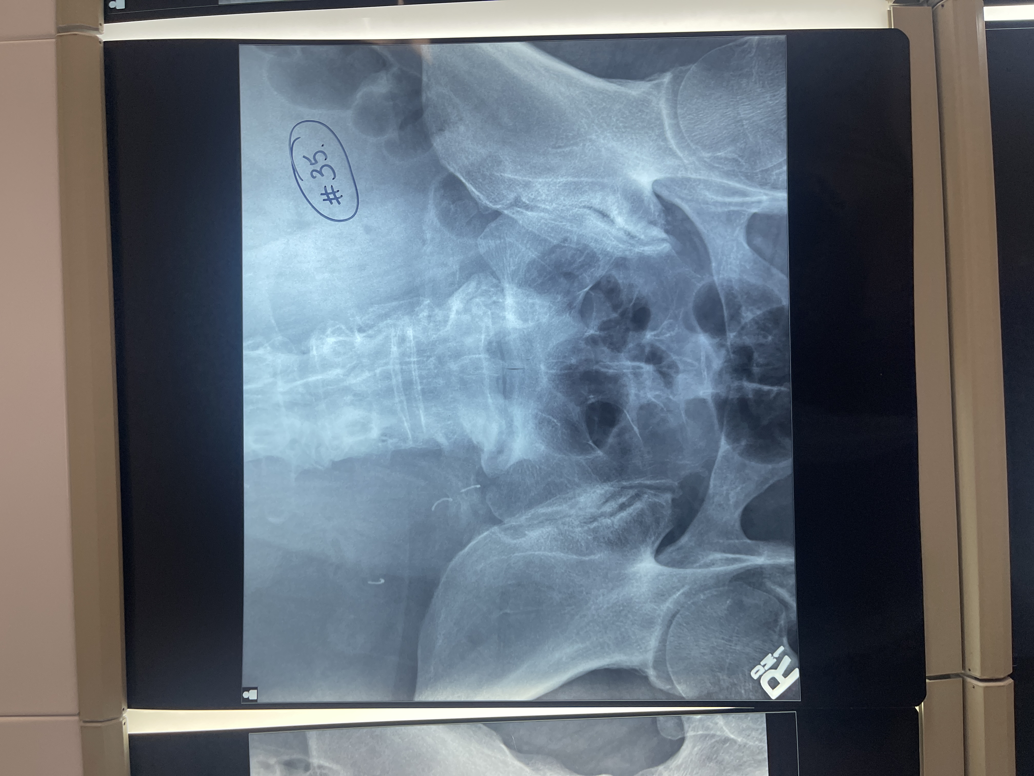 <p>What’s wrong with #35 AP axial sacrum </p>