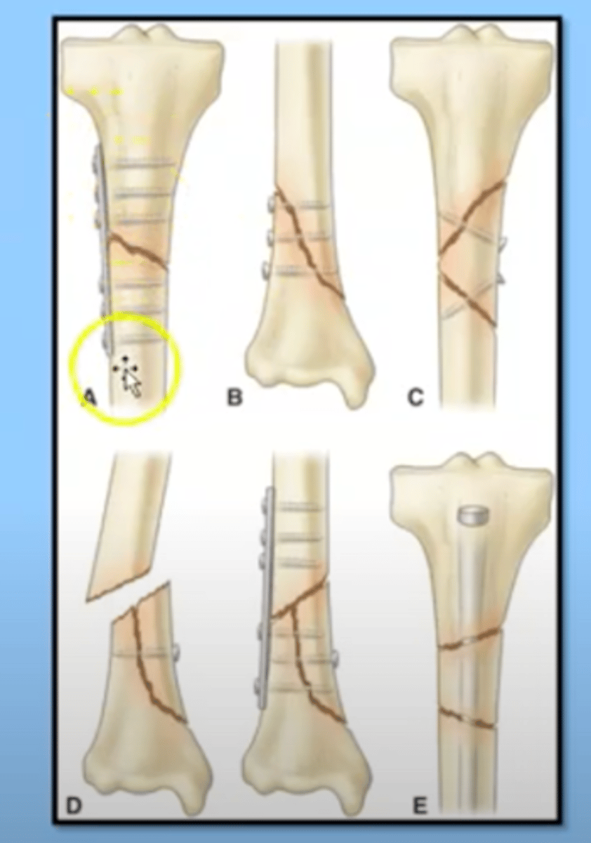 <p>placed in surgery and the skin is closed over</p>