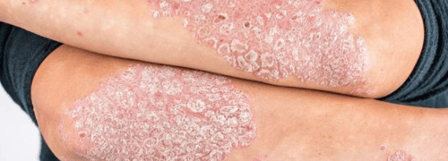 <p>¿lesión?</p><p>¿primaria o secundaria?</p>