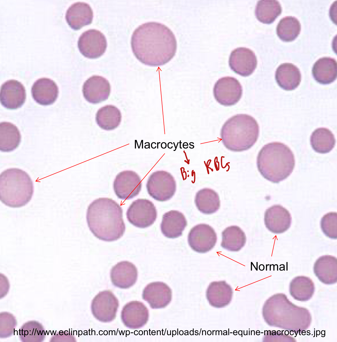 <ol><li><p>Accelerated erythropoiesis</p><ol><li><p>Young RBCs are larger than mature ones, therefore, the accelerated production of erythrocytes can cause an <u>inc in the MCV</u></p></li></ol></li><li><p>FeLV</p><ol><li><p>FeLV can cause <span style="color: red;">non-regenerative anemia</span> in cats</p></li><li><p>The bone marrow isn’t producing enough RBCs to replace the lost ones, this high inc in young RBCs leads to an increase of MCV</p></li></ol></li></ol><p></p>