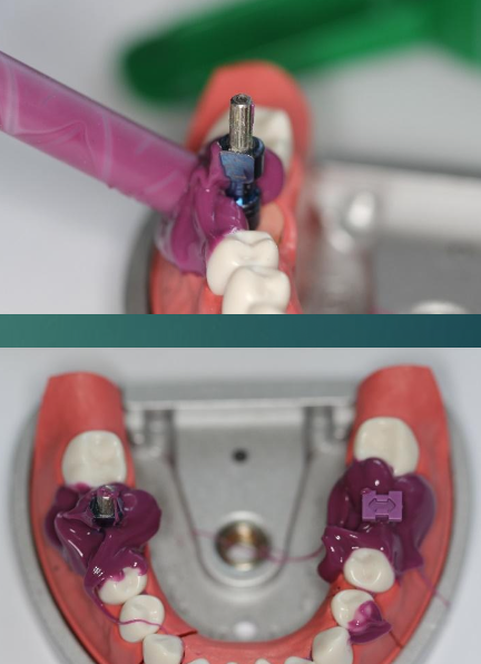 <p>What is the impression procedure?</p>